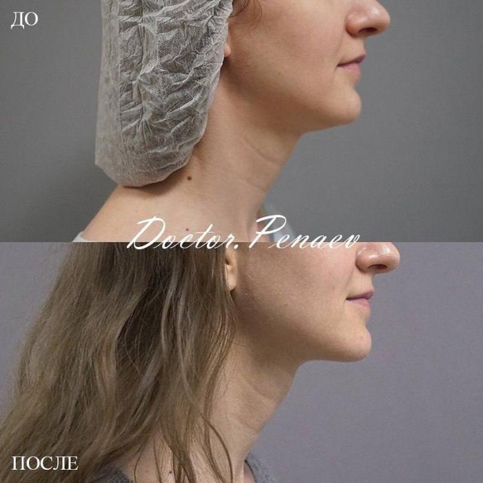 Выполнен лифтинг овала лица и подбородка специальными нитями Spring Thread