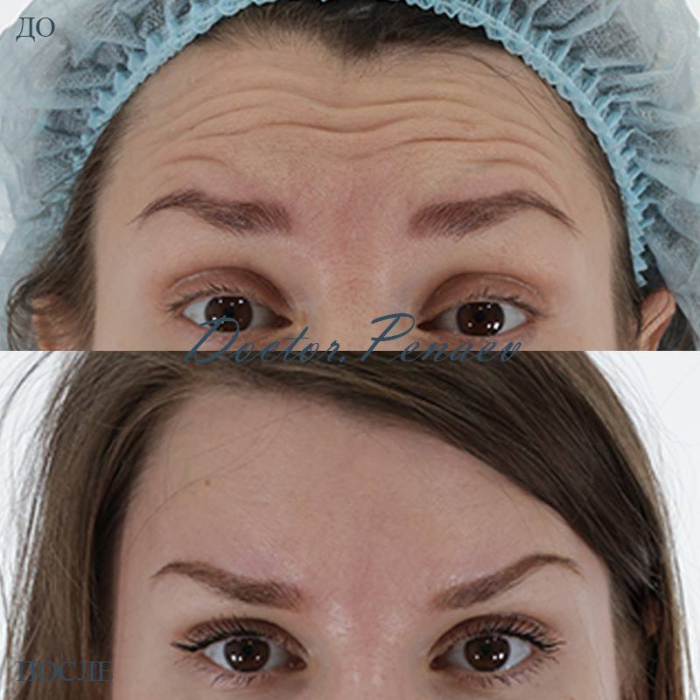 вечный ботокс Пенаев