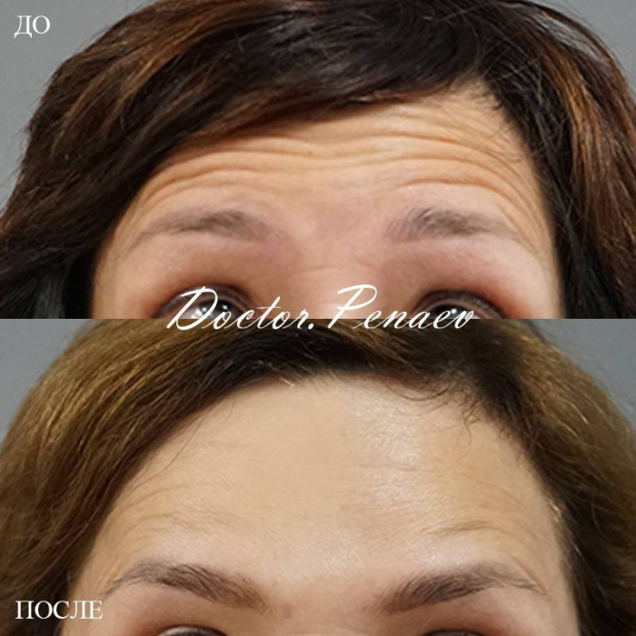 вечный ботокс Пенаев