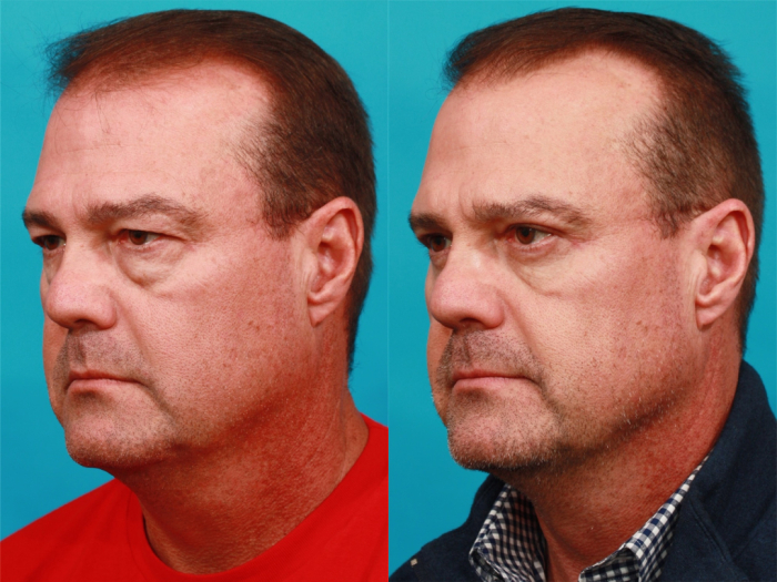 Пациент доктора Гукаса Миракяна до и после блефаропластики