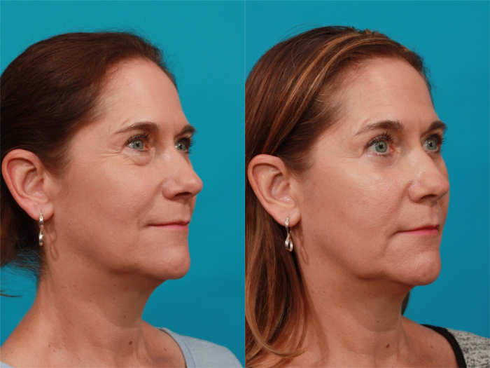 Пациентка доктора Гукаса Миракяна до и после блефаропластики